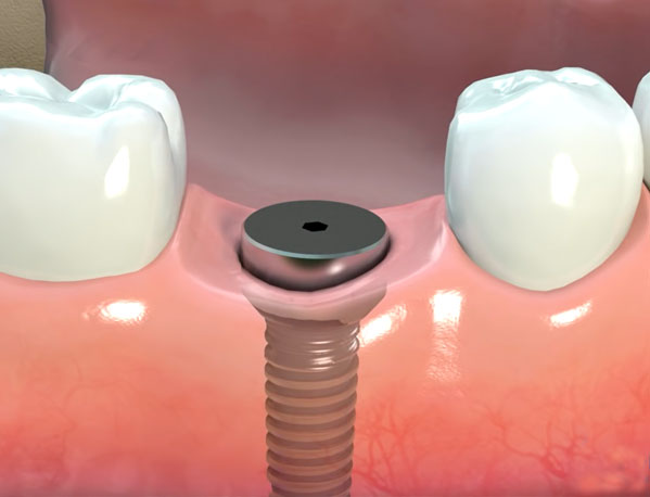 Parker Family Dental Dental Implants Update