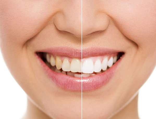 Dental-Bonding-Procedure-Parker-Dental-Group