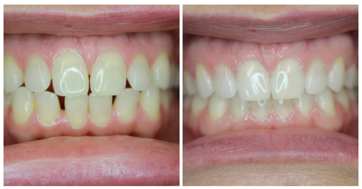 Dental-Bonding-before-after-Parker-Dental-2
