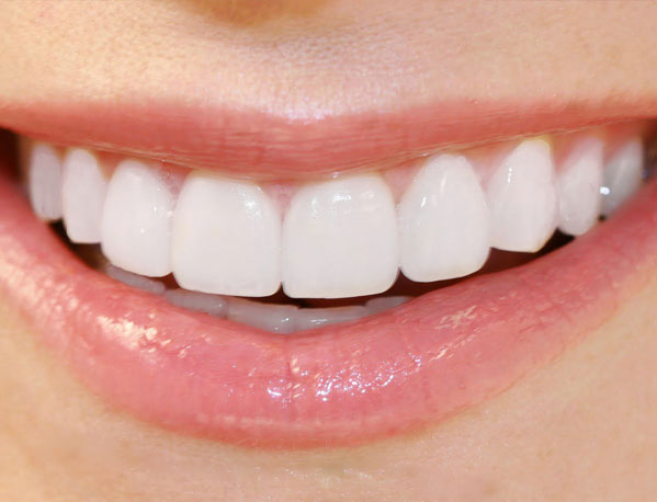 Parker-Dental-Group-Composite-Dental-Vaneers