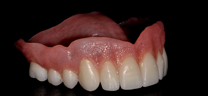 Parker-Dental-Group-Traditional-Dentures