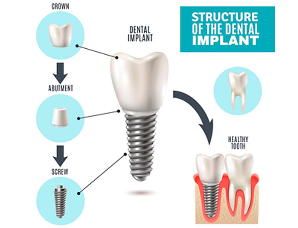 Parker-Family-Dental-Dental-Implants-More