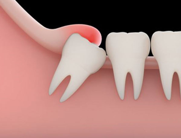 Parker Family Dental Dental Wisdom Teeth Removal
